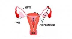 子宫肌瘤8cm生育挑战：顺产风险与治疗方案探讨