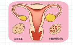 多囊卵巢要做哪些检查？这些指标非常重要！