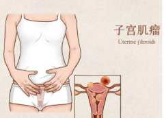 子宫肌瘤会不会自己变小？绝经和子宫肌瘤之间有关系吗？