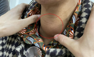 甲状腺疾病会遗传给孩子吗？