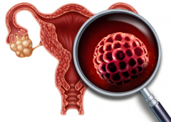 <b>【好柿生殖】巧克力囊肿能直接做试管吗?巧克力囊肿试管成功率有多少</b>