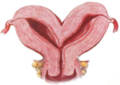 双角子宫先矫正再做试管婴儿成功率会更高吗？